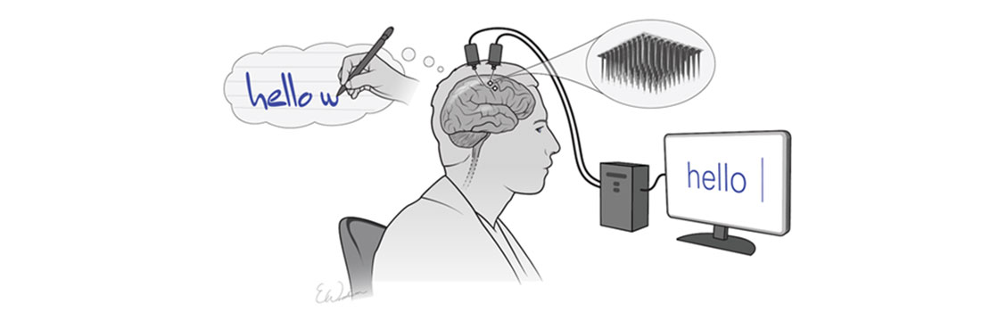 Brain implant turns thoughts into text